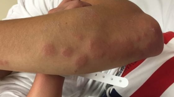 “بق الفراش” يجتاح باريس والحكومة تتحرك