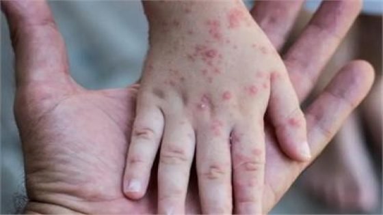 وزارة الصحة المصرية تنفي تسجيل حالة إصابة بجدري القردة