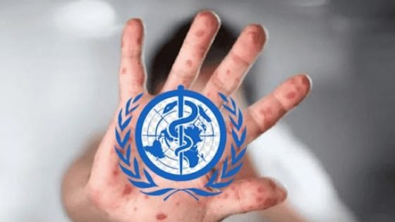 منظمة الصحة العالمية تطلق خطة إستراتيجية عالمية لإحتواء تفشي جدري القردة