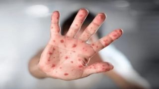 من الأعراض إلى الوقاية: كل ما تحتاج معرفته عن جدري القردة