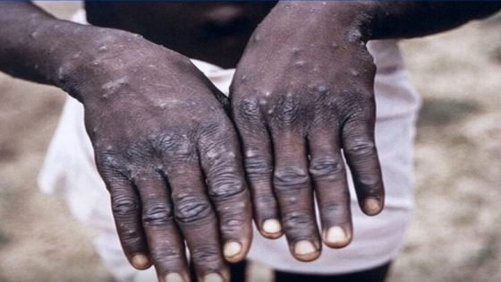 أزيد من 2700 حالة إصابة جديدة بجدري القردة في إفريقيا في ظرف أسبوع