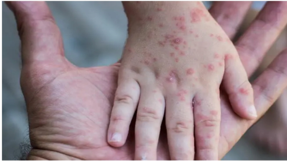 رسميا..تسجيل أول إصابة بجدري القردة في فرنسا