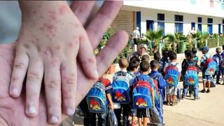 تفشي الحصبة في المدارس.. إجراءات جديدة تشمل الاستبعاد والتعليم عن بعد