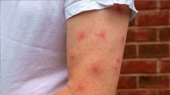 تراجع مستمر في إصابات الحصبة “بوحمرون” للأسبوع الخامس على التوالي